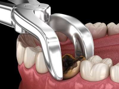 Illustration of tooth being extracted