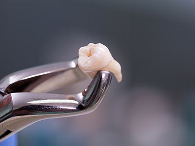 Forceps grasping an extracted tooth