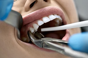 Closeup of a woman’s tooth being extracted with forceps