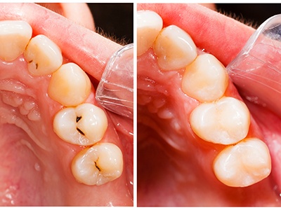 Cavities filled with Tooth-colored fillings in Fort Worth, TX